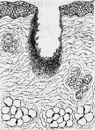 �˿���������֢��Ӧ��