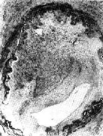 ������Ѫ˨